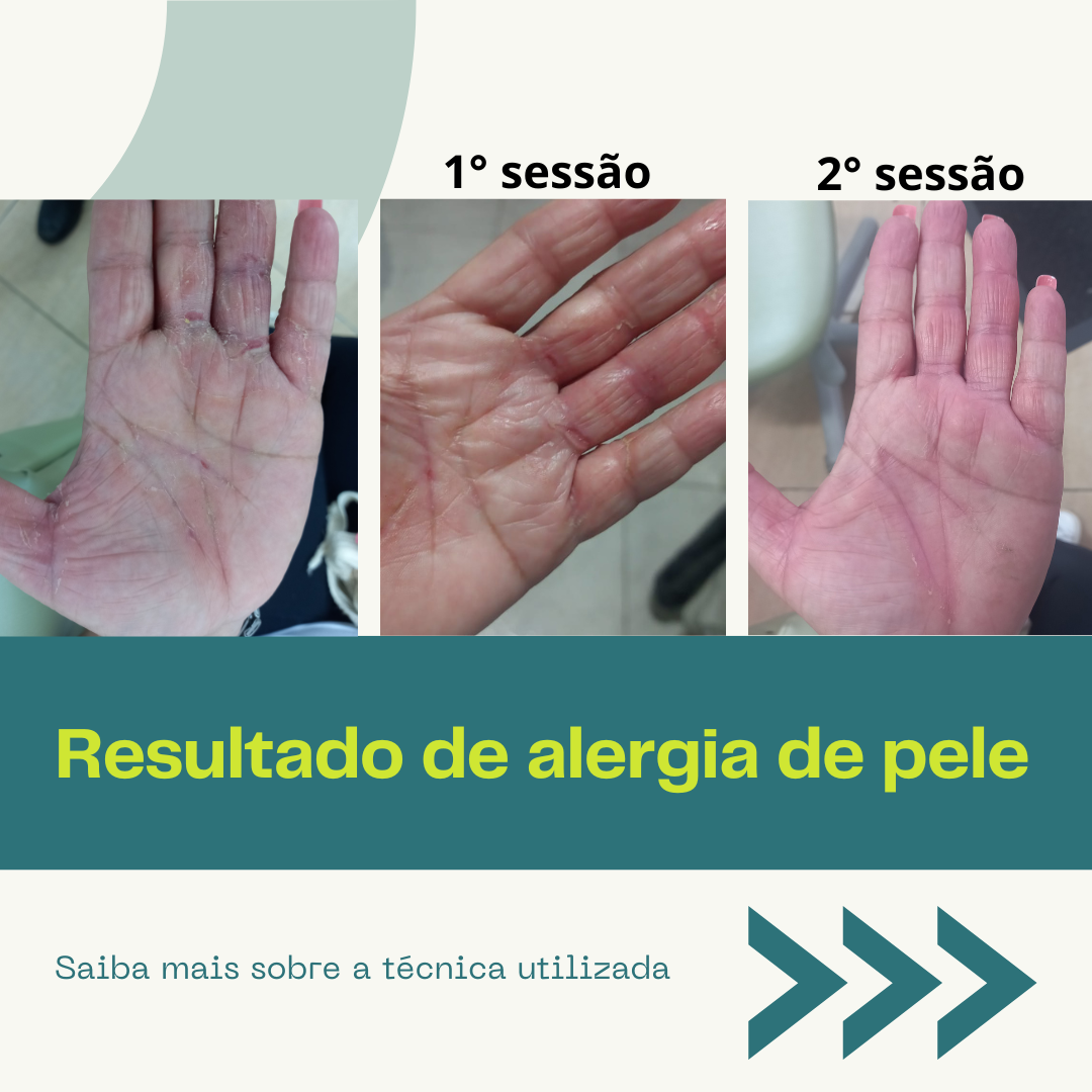 Post sobre alergia de pele