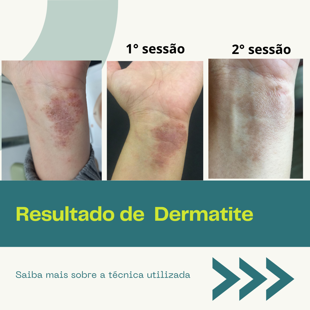 Post sobre dermatite